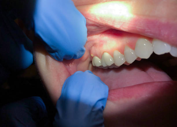 Best Tooth Infection Emergency Dentist  in Sheridan, IN
